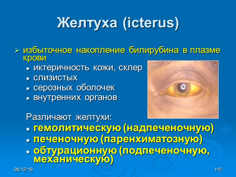 08:12:02 115 Желтуха (icterus) избыточное накопление билирубина в плазме крови иктеричность кожи, склер 
